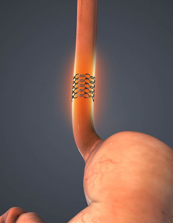 Dilation and metal stenting procedure in Vijayawada