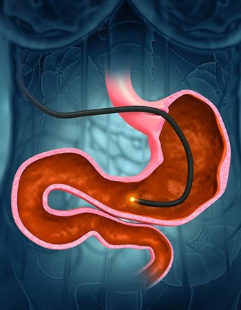 Endoscopy procedure for digestive disorders in Vijayawada