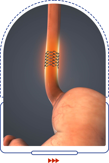 Dilation & Metal Stenting icon