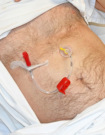 PEG tube placement procedure in Vijayawada